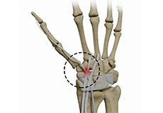 Distal Intersection Syndrome