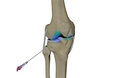 Intraarticular Knee Injection