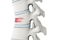 Spinal Fractures